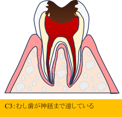 C2:中等度のむし歯