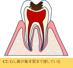 C3:大きなむし歯