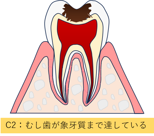 中等度の虫歯（C2）