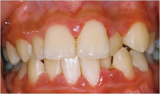 慢性歯周炎の歯茎