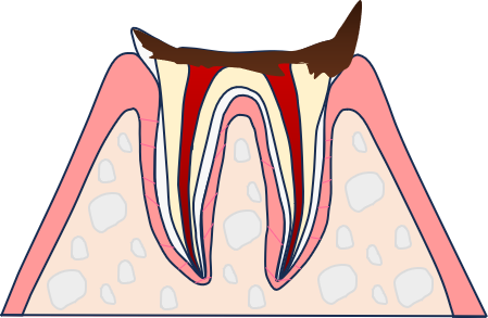 C4:歯の頭の部分がすべて崩壊
