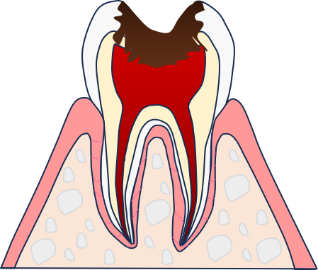 C3:神経まで虫歯が進行
