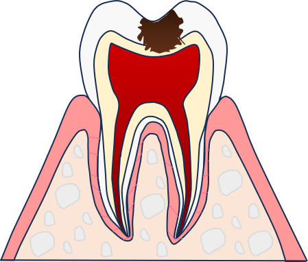 C2:象牙質まで虫歯が進行