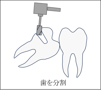 歯の頭が一部だけでている場合の親しらずの抜歯方法1