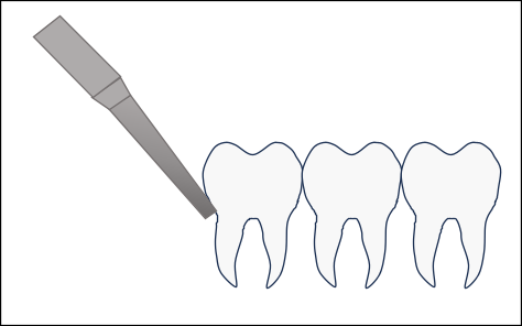 歯の頭がすべて生えている場合の親しらずの抜歯方法1
