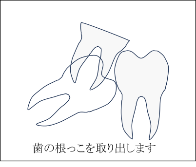 歯の頭が一部だけでている場合の親しらずの抜歯方法3