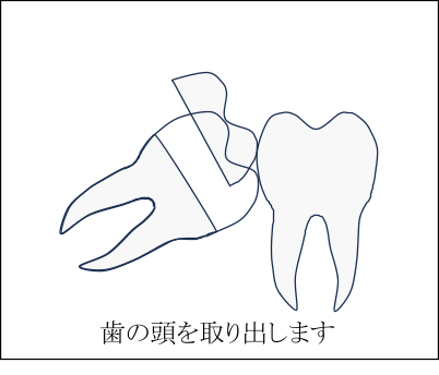 歯の頭が一部だけでている場合の親しらずの抜歯方法2